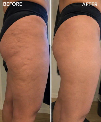 Cryo Thermo Gel – Fades Cellulite & Stretch Marks